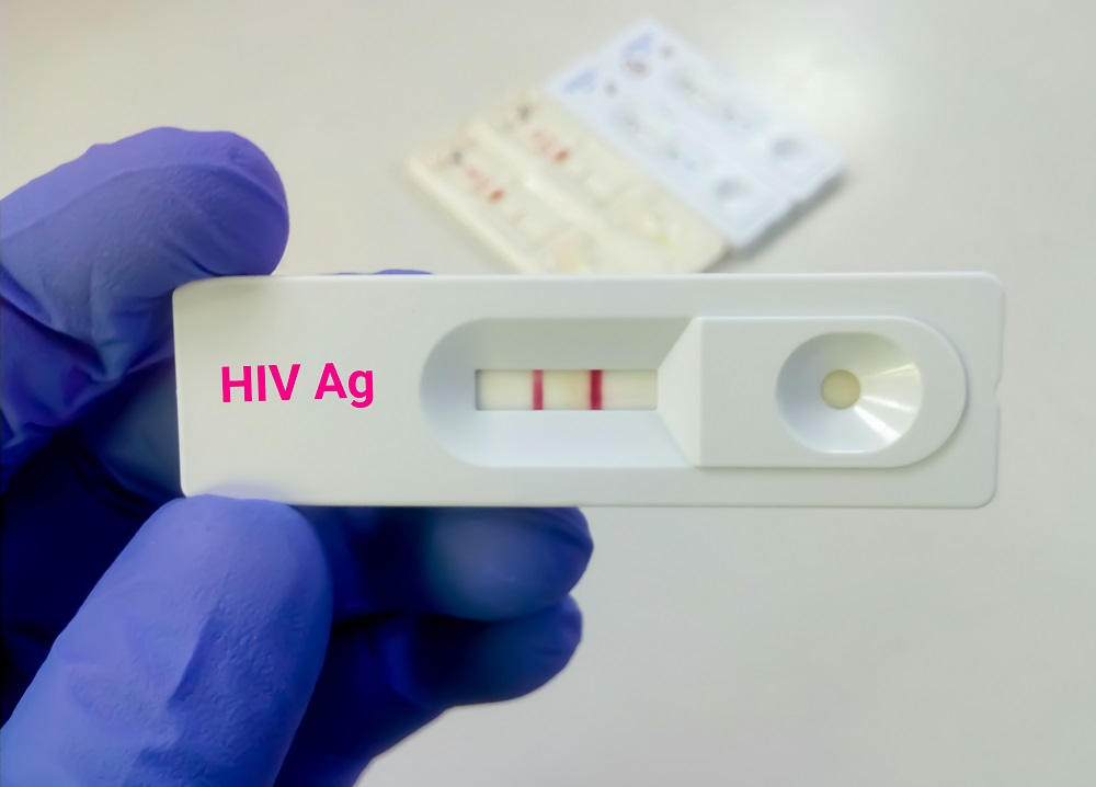 HIV antigen positive test result by using rapid test cassette
